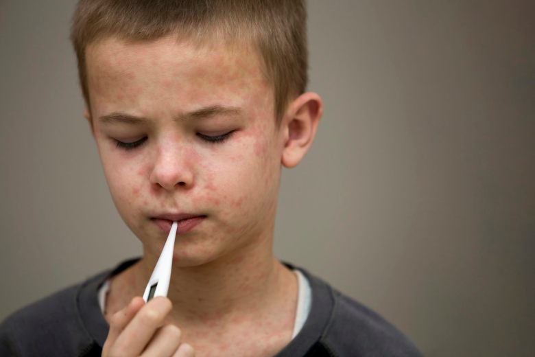 A young boy with measles holds a thermometer in his mouth
